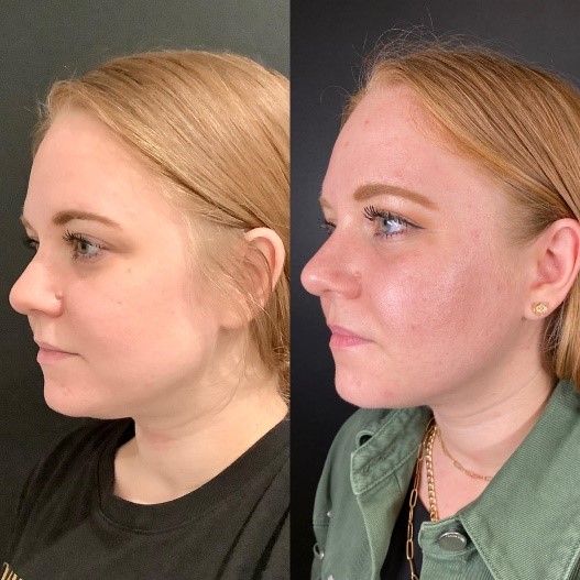 Kybella melts away stubborn fat under your chin for a slimmer, defined jawline. Non-surgical, FDA-approved, and long-lasting. Book your consultation today!