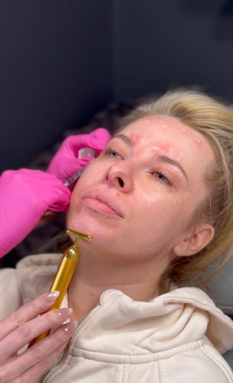 masseter botox
