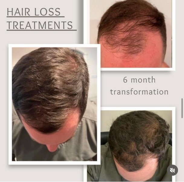 Boost hair growth with PRF hair restoration! A natural, safe, and effective way to combat hair loss and restore thicker, healthier hair. Learn more today.